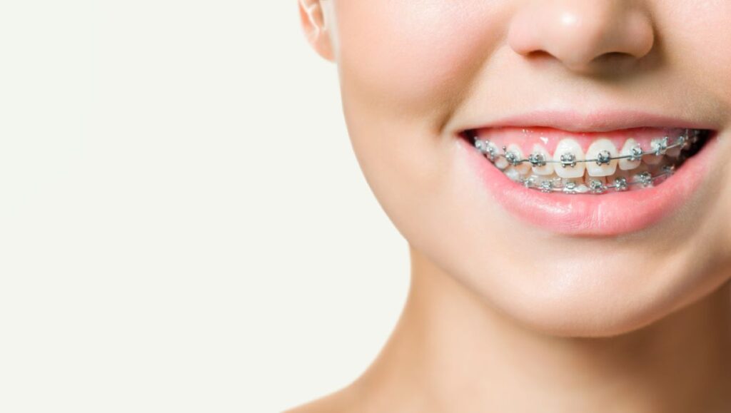dental-braces-versus-invisalign