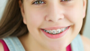 league-city-pediatric-dentist-braces_thumbnail