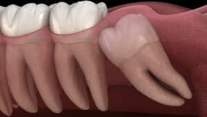 wisdom-teeth-league-city-dentist_thumbnail