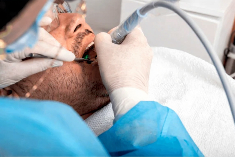 Scaling-for-Gingivitis